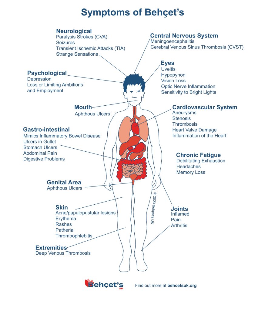 An illustrated diagram shows the wide range of symptoms of Behçet's in the human body. 