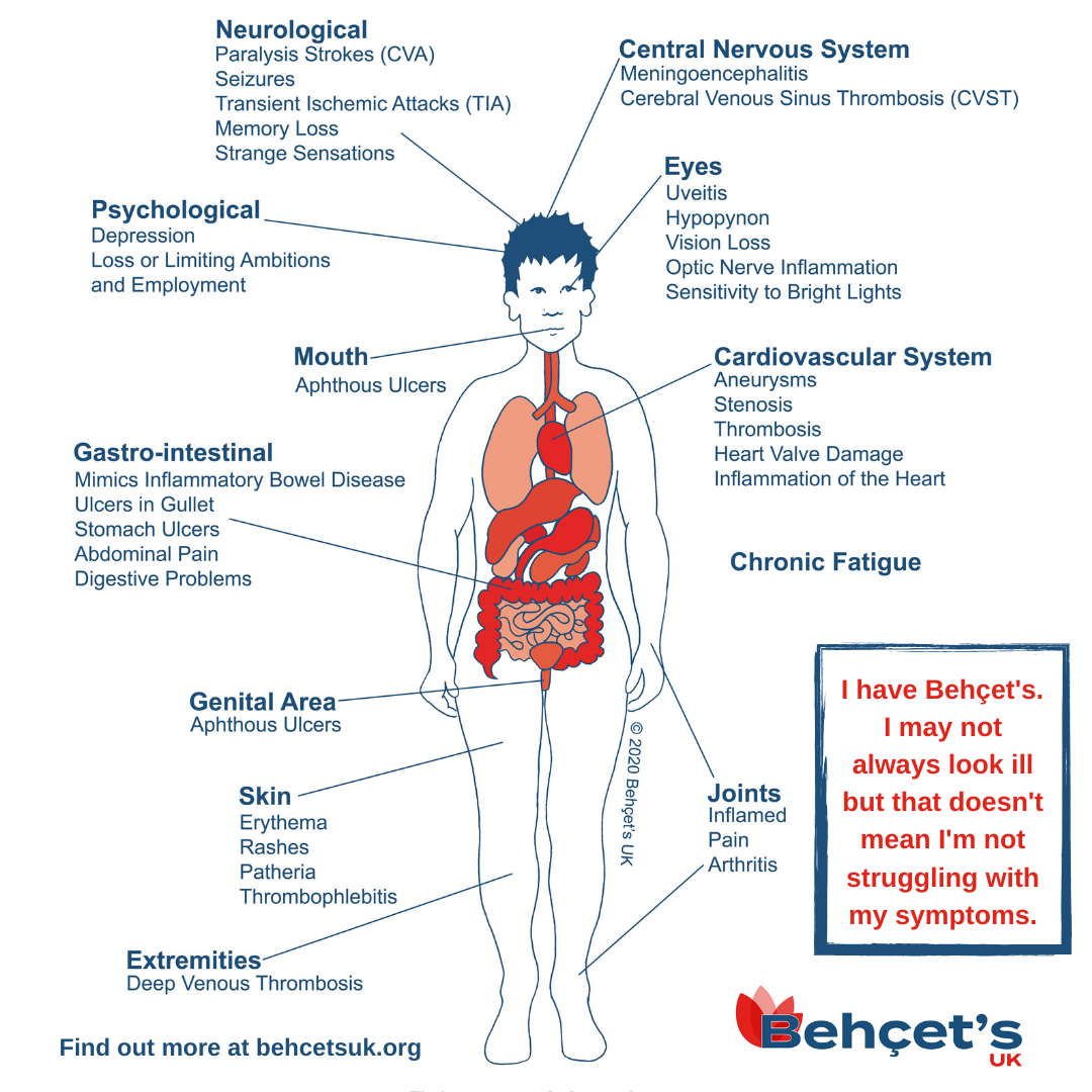 Diagram of Behçet's Symptoms