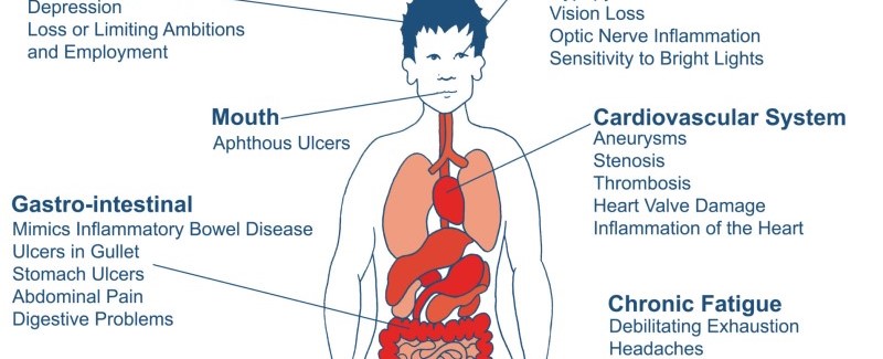 An illustrated diagram shows some of the Behçet's symptoms, such as mouth ulcers, and gastro-intestinal symptoms.